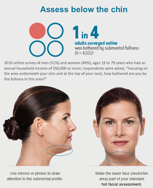 Kybella for double chin