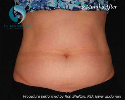 3 Months After CoolSculpting