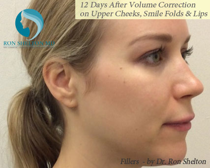 12 Days After Voluma to Upper cheeks, Vollure to smile folds and marionette lines and Volbella to lips