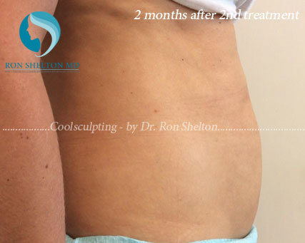 Coolsculpting 2 Months After 2nd Treatment