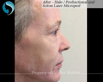 After - Halo / Profractional and Sciton Laser Micropeel