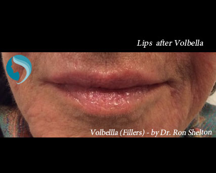 Post Operative Volbella