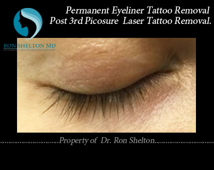 Completely resolved permanent eyeliner tattoo
