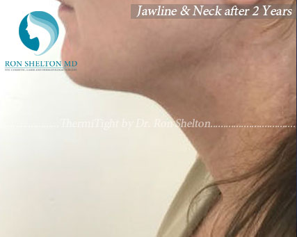 Jawline & Neck after 2 years