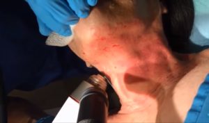 Image shows Microneedling on a patient by Dr. Shelton