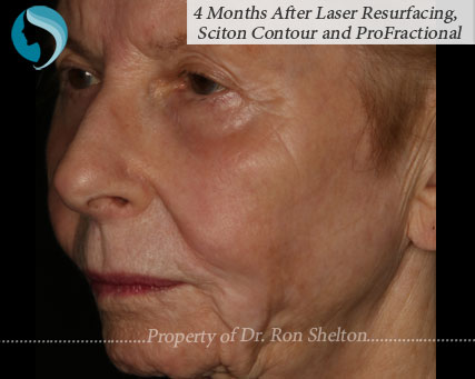 photo of 4 Months After Laser Resurfacing, Sciton Contour and Profractional