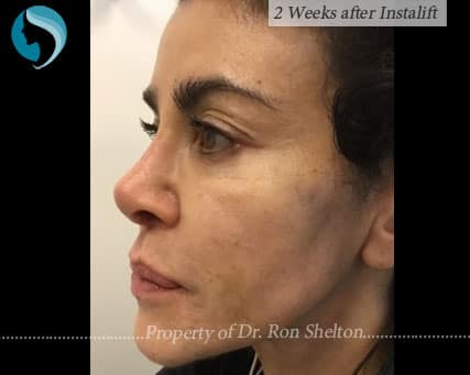 2 Weeks after Silhouette InstaLift Suture Lift for Cheek Augmentation