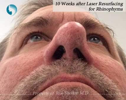 10 Weeks after Laser Resurfacing of Rhinophyma