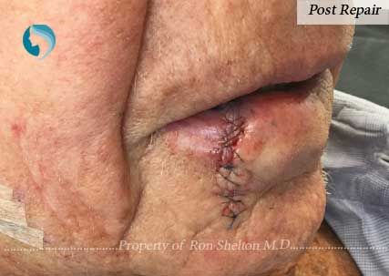 Mohs Repair by Dr Shelton