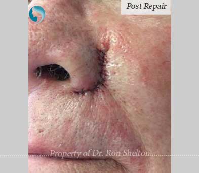 Mohs Repair by Dr Ron Shelton