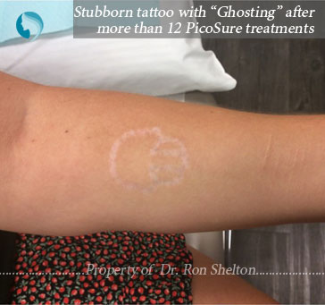 Stubborn tattoo with “Ghosting” after PicoSure treatments