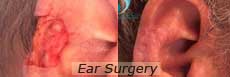 Ear surgery in nyc