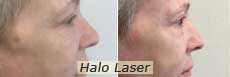 Halo Laser in NYC