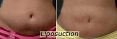 Liposuction in NYC