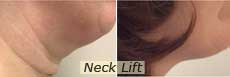 Neck lift in NYC