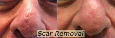 Scar Removal