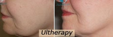 ultherapy nyc