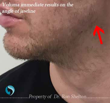 Voluma immediate results on the angle of jawline