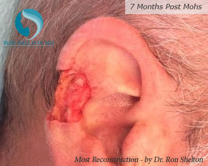 Post Operative Ear Graft