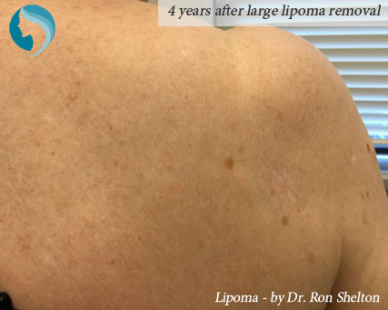 4 years after large lipoma removal - right posterior shoulder