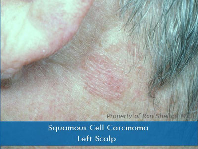 Actinic Keratosis and Squamous Cell Carcinoma