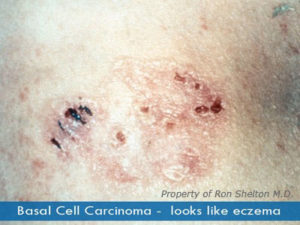 Skin Cancer New York | Basal Cell Carcinoma - Ron Shelton MD