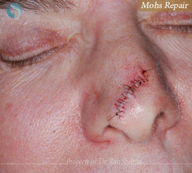 Mohs Repair by Ron Shelton MD