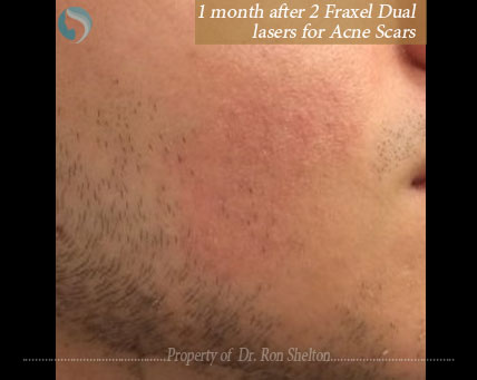 Fraxel for acne scars