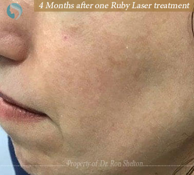 4 months after 1 ruby laser treatment