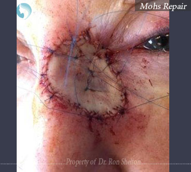 The life of a skin graft – Mohs procedure New York