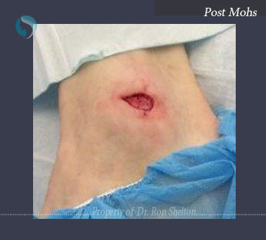 Post Mohs of Squamous Cell Carcinoma left outer ankle.
