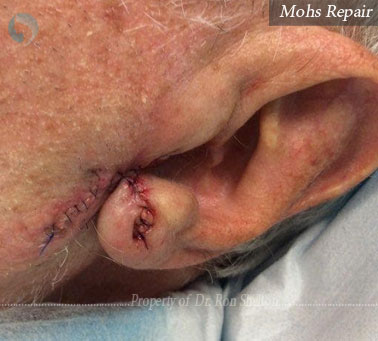 mohs repair ear
