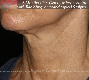 3 months after Genius Microneedling with Radiofrequency and topical Sculptra