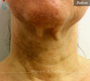 Before infini microneedling for techneck