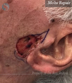 Post Mohs surgery on ear