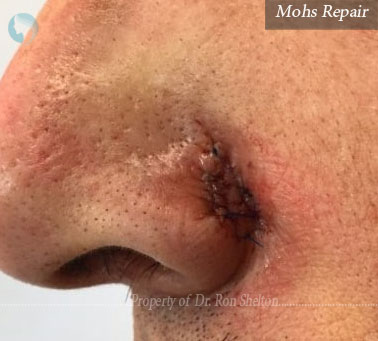 Mohs Repair on the nose