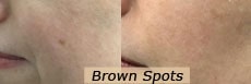 Brown spots removal