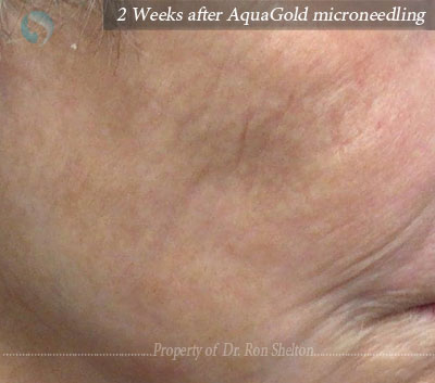 AquaGold microneedling with topical application of dilute Botox and Hyaluronic acid filler to improve texture of the skin.  