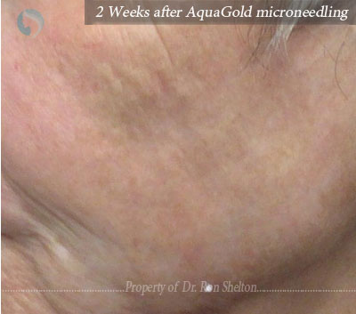 AquaGold microneedling with topical application of dilute Botox and Hyaluronic acid filler to improve texture of the skin.  