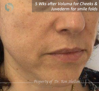 5 Wks after Voluma for cheeks and Juvederm for smile folds