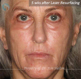 After Laser Resurfacing for laser resurfacing for deep Sun damage and wrinkles