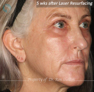 After Laser Resurfacing for laser resurfacing for deep Sun damage and wrinkles