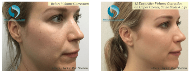 Combination Treatments using Botox™ and Dermal Fillers
