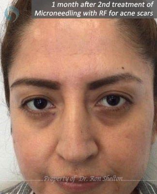 1 month after 2nd treatment of Microneedling with RF for acne scars