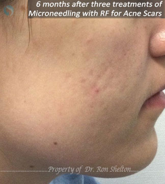 6 months after 3rd treatment of Microneedling with RF for acne scars