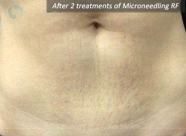 After 2 treatments of Microneedling RF