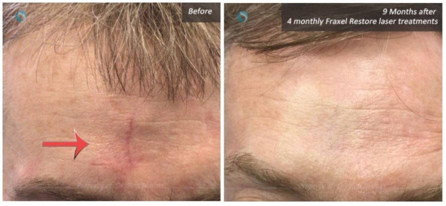Fraxel scar removal nyc