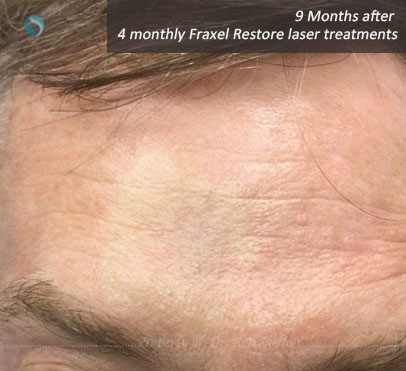 9 Months after 4 Monthly Fraxel Restore laser treatments
