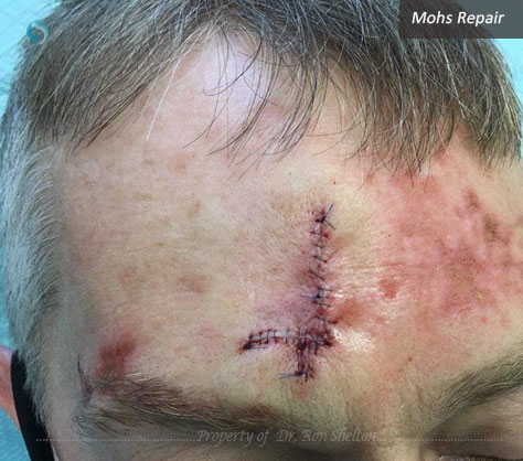 Mohs repair on forehead by Dr Shelton