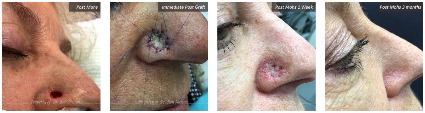 mohs graft by mohs surgeon nyc